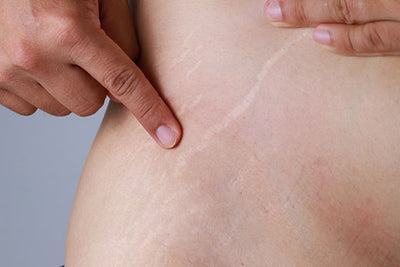 5 Efficient Ways to Get Rid of Stretch Marks fast