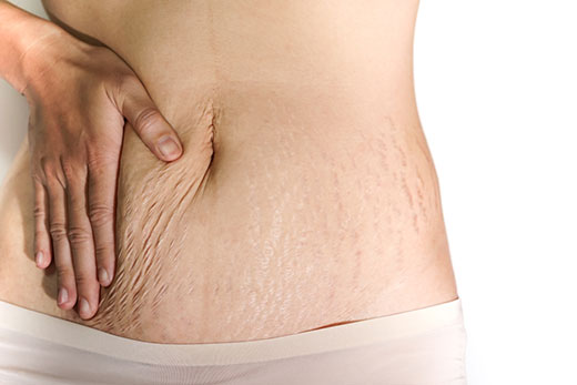 Do Stretch Marks Get Rid After Easily Weight Loss? StretcHeal Do Stretch Marks Get Rid After Easily Weight Loss? StretcHeal
