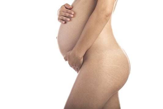Natural remedies to reduce deep stretch marks