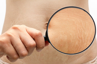 4 Ways to Prevent Stretch Marks