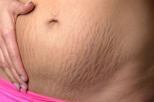 7 Things You Need to Know about Stretch Marks