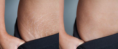Home Remedies for Stretch Marks to Fade Fast