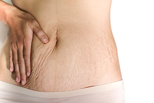 Stretch Marks after Weight Loss