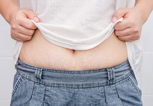 3 Myths About Stretch Marks