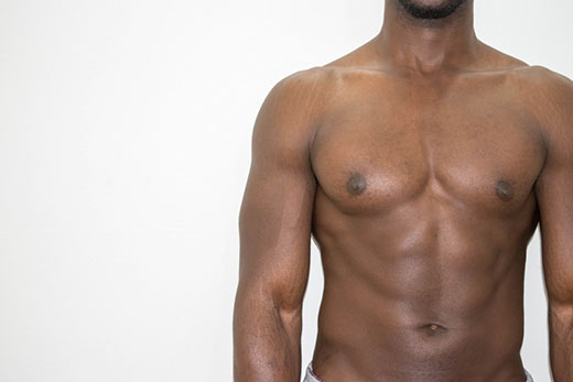 Removing stretch marks caused by bodybuilding (permanently)