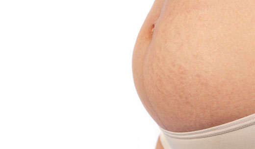 What is The Best Stretch Mark Cream For White Women