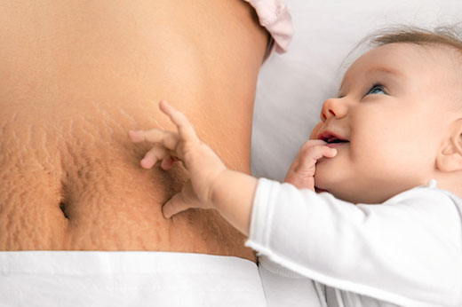 Are Stretch Mark Creams Only for Post-Pregnancy Women?