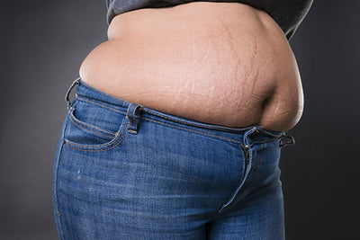 Different Types of Stretch Marks and Definitive Cure