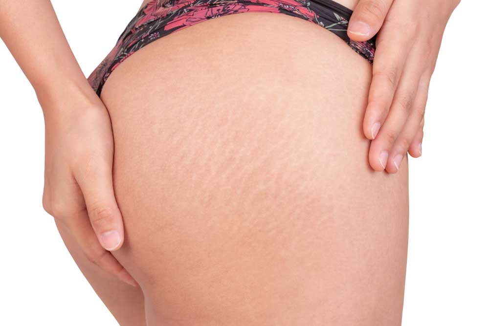 most important causes of stretch marks on the buttocks