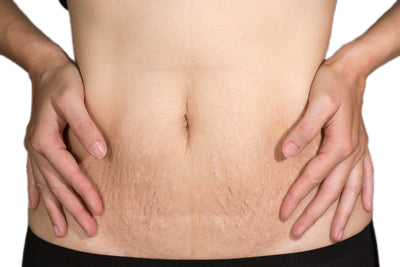 Stretch Marks: Causes and Treatments